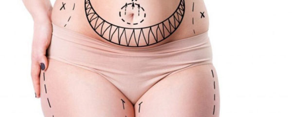 liposuccion
