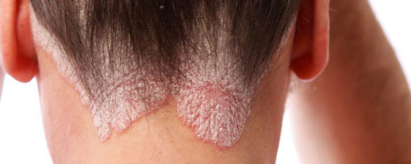 l'eczéma du cuir chevelu